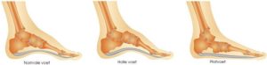 Patellofemoraal pijnsyndroom voetafwijkingen