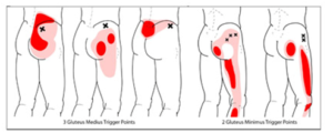 Piriformis syndroom triggerpoints