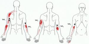 Triceps triggerpoints