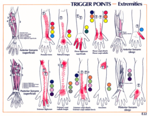 Triggerpoints carpaal tunnel syndroom
