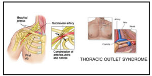 Wat is Thoracic outlet syndroom