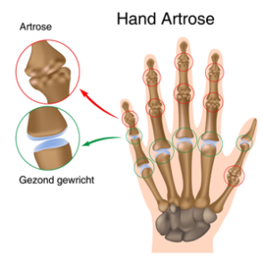 artrose handen pijn
