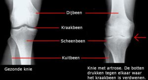 artrose knie rontgenfoto