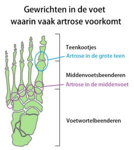artrose voet teen