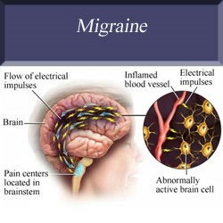 migraine hoe ontstaat het