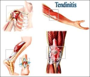 peesontsteking tendinitis