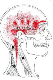 triggerpoint pijn zijkant hoofd